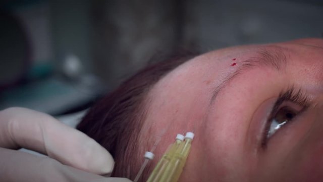 4K Doctor Applying PDO Thread Lifts in Woman Forehead