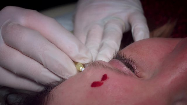 4K Doctor Inserting Thread Lift with Needle