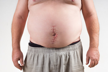 A scar on the big man's stomach