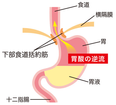 胃酸の逆流　逆流性食道炎
