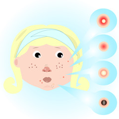 girl with acne problems