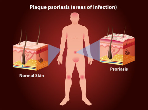 Diagram Showing Plaque Psoriasis In Human