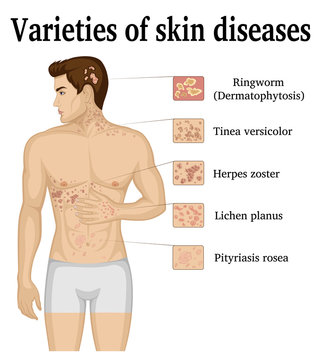 Varieties of skin diseases