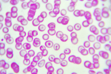 Abnormal red blood cells from anemia patient