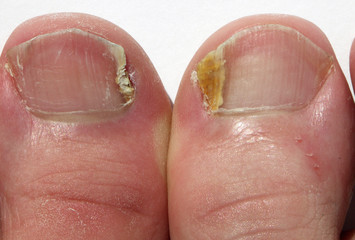Fungal Nail Infection  on big toes