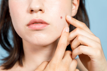 Obraz na płótnie Canvas young woman who checks her skin. acne treatment.