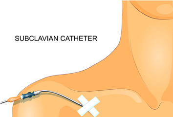 the staging of the subclavian catheter - obrazy, fototapety, plakaty