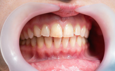 Close up of woman’s teeth