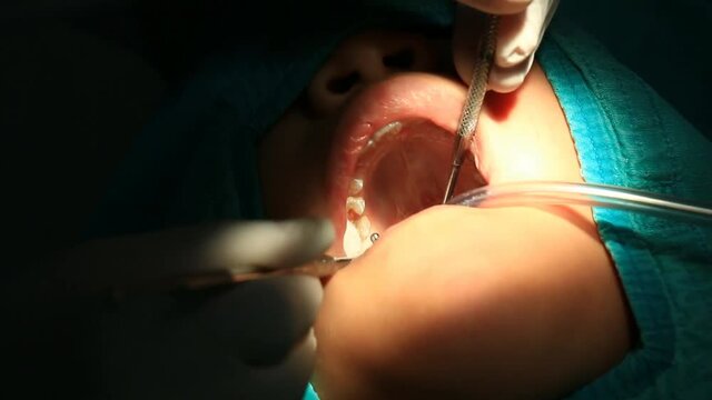 Dentist Checking And Treating Tooth Decay (handheld shot)