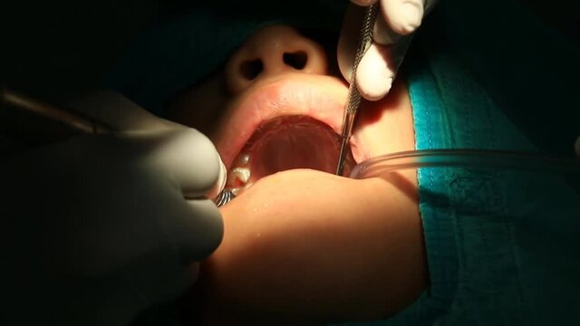Dentist Checking And Treating Tooth Decay (handheld shot)