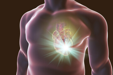 Heart attack, conceptual image for heart diseases. 3D illustration