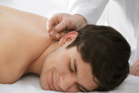 Handsome man at acupuncture treatment