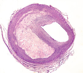 Atheroma plaque