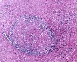 Tuberculosis granuloma. Langhans cell