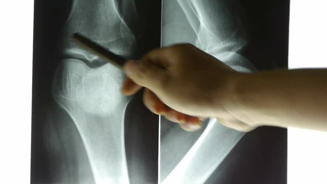 doctors study arm,leg joints X-ray film for analysis.
