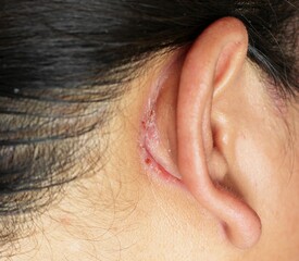 wound behind ear