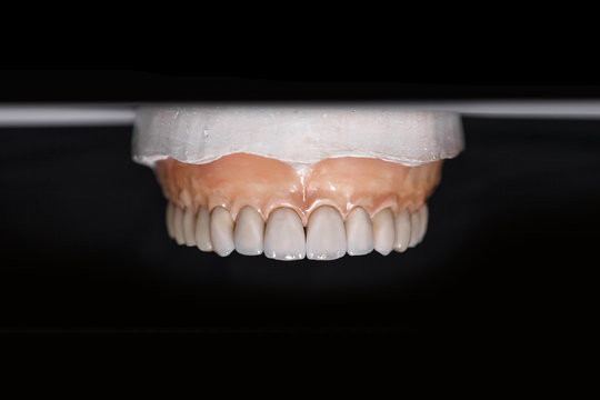 Ceramic teeth dental crowns on model, metal free - front view . Ceramic front veneers isolated on black background. Metal-Ceramic crowns on gypsum model in dental laboratory.