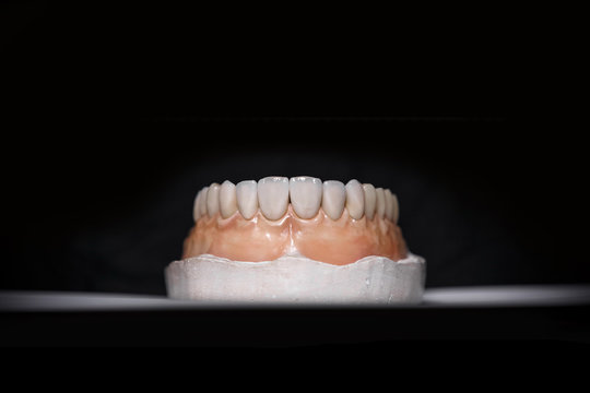 Ceramic teeth dental crowns on model, metal free - front view . Ceramic front veneers isolated on black background. Metal-Ceramic crowns on gypsum model in dental laboratory.