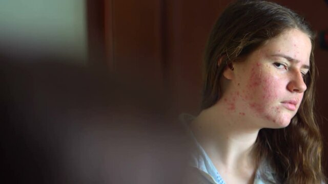 The teenager with acne looks at himself in the mirror, close-up