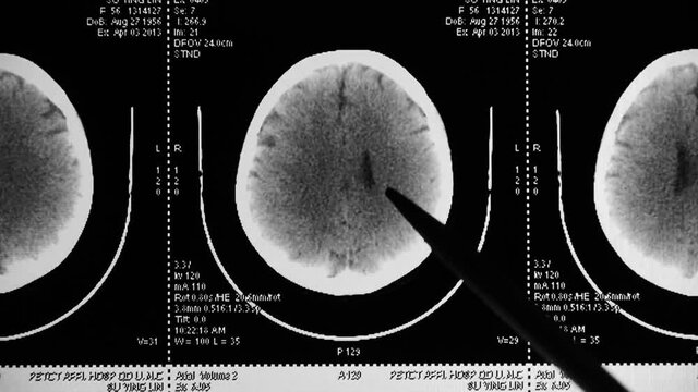 doctor study head pet/ct scan for analysis the disease,skull brain X-ray.	