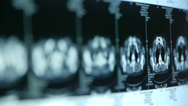 human subclavian pet-ct scan,lymph nodes X-ray,Cancer metastasis.	