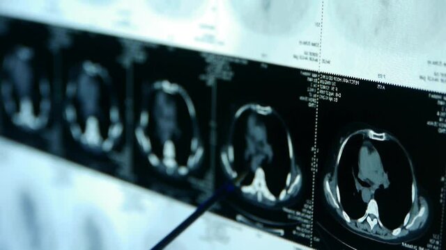 doctor study Breast pet-ct scan,medical x-ray.	