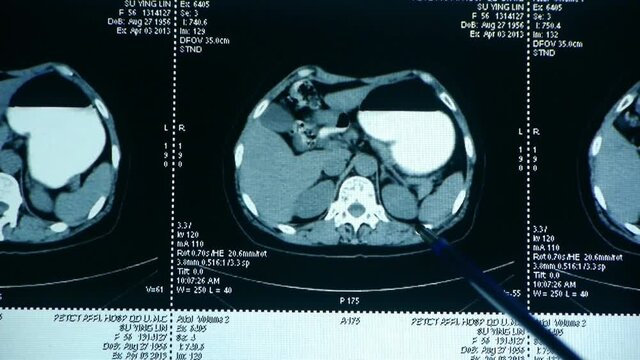 doctor study Gallbladder pet-ct scan,human organ X-ray radiography.