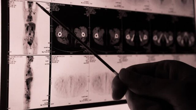 doctor study human orage & bone pet-ct scan,X-ray,Cancer metastasis.