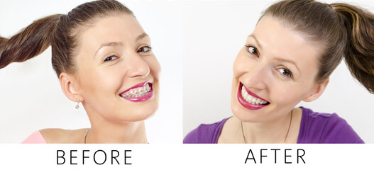 Before and after dental braces, beautiful young woman with braces and after correction process, smiling 