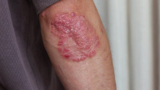 Arms of a person with psoriasis