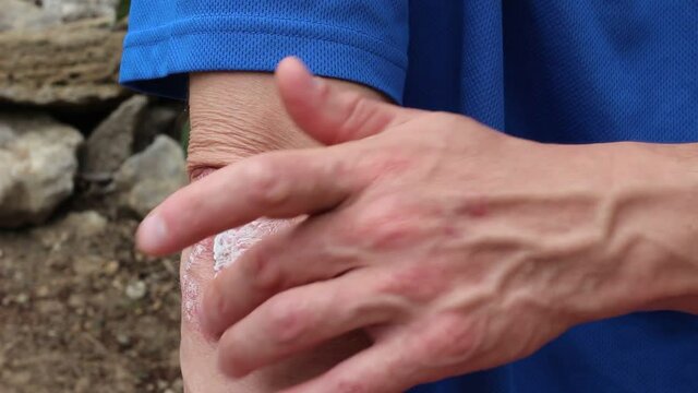 Plaque Psoriasis on elbow. The mainstay of psoriasis treatment, steroid creams decrease inflammation, relieve itching, and block the production of cells that are overproduced in psoriasis