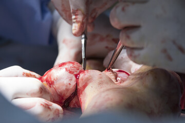 surgeon cuts the finger with a scalpel during the amputation close up