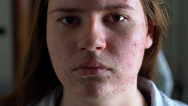 Depressed girl with acne problem