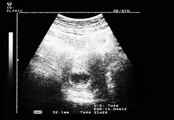 An ultrasound of a human fetus during the 7th week. - obrazy, fototapety, plakaty