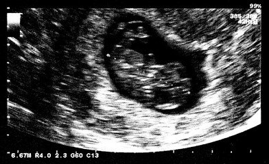 An ultrasound of a human fetus during the 7th week.