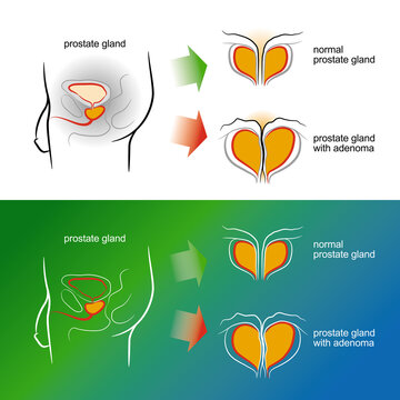 Sketch of a male prostate gland with adenoma. Vector illustration
