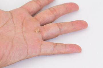 Wound on hand