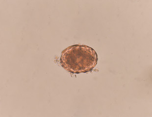 Ascaris lumbricoides egg in stool exam.