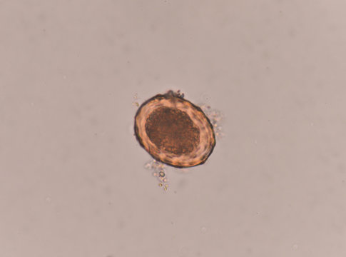 Ascaris Lumbricoides Egg In Stool Exam.