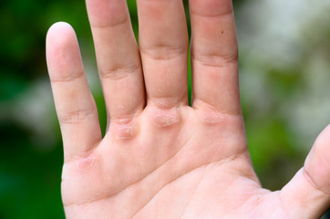 Hand with callus