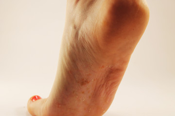 Fototapeta premium Fungus of foot close-up, isolated on white background. The concept dermatology, treatment fungal and fungal infections in humans. Macro photograph human parasites. Rear background of a dermatologist