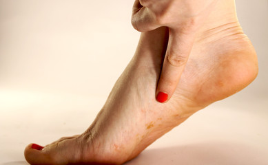 Fungus of foot close-up, isolated on white background. The concept dermatology, treatment fungal...