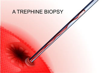 trephine biopsy cancer tumor