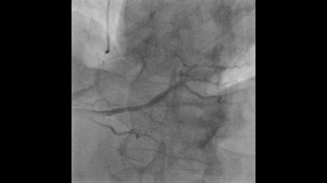 Coronary angiography