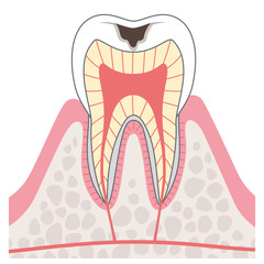 虫歯　断面図　医療