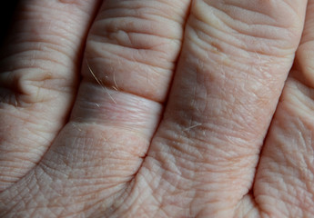 Part of a human hand where one finger has marks of a finger ring that has been removed.