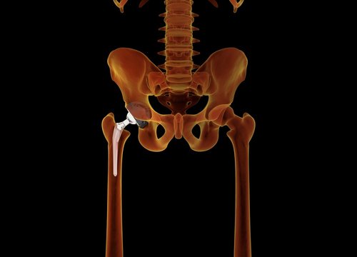 Medically accurate illustration of the hip replacement. 3d illustration.