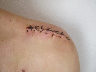 Fresh wound with surgical suture in case of fracture of clavicle