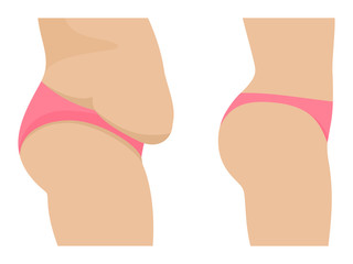 Vector female abdomen before after losing weight