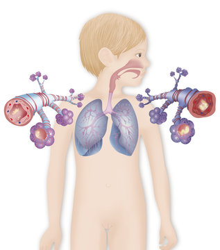 Depiction of a healthy bronchial tube (left) and a bronchial tube during an asthma attack (right)